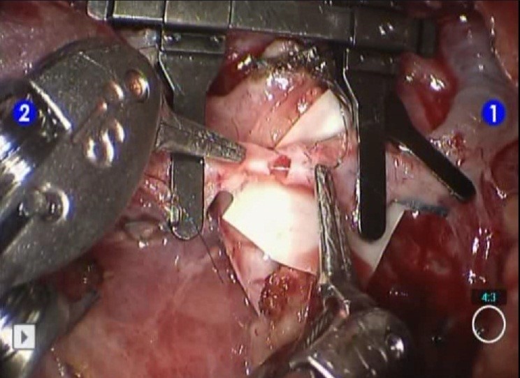 Figure 1. The anastomosis was performed robotically.jpg